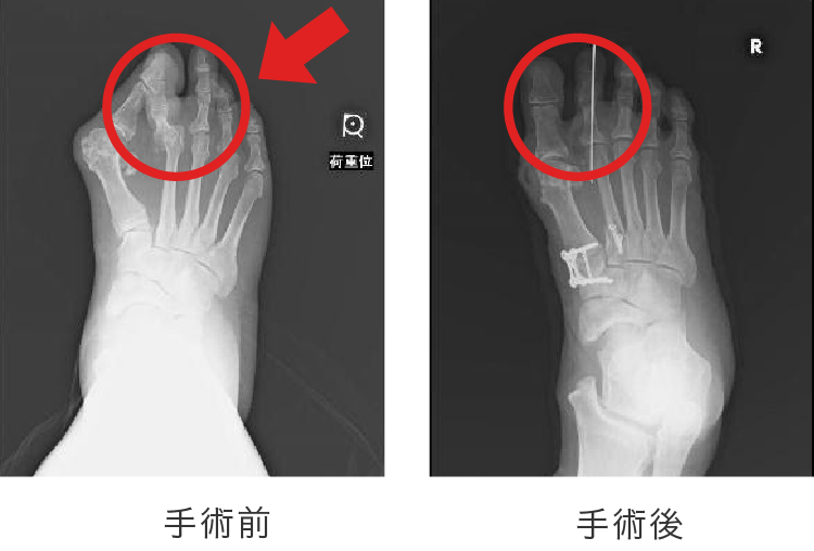 外反母趾手術前後