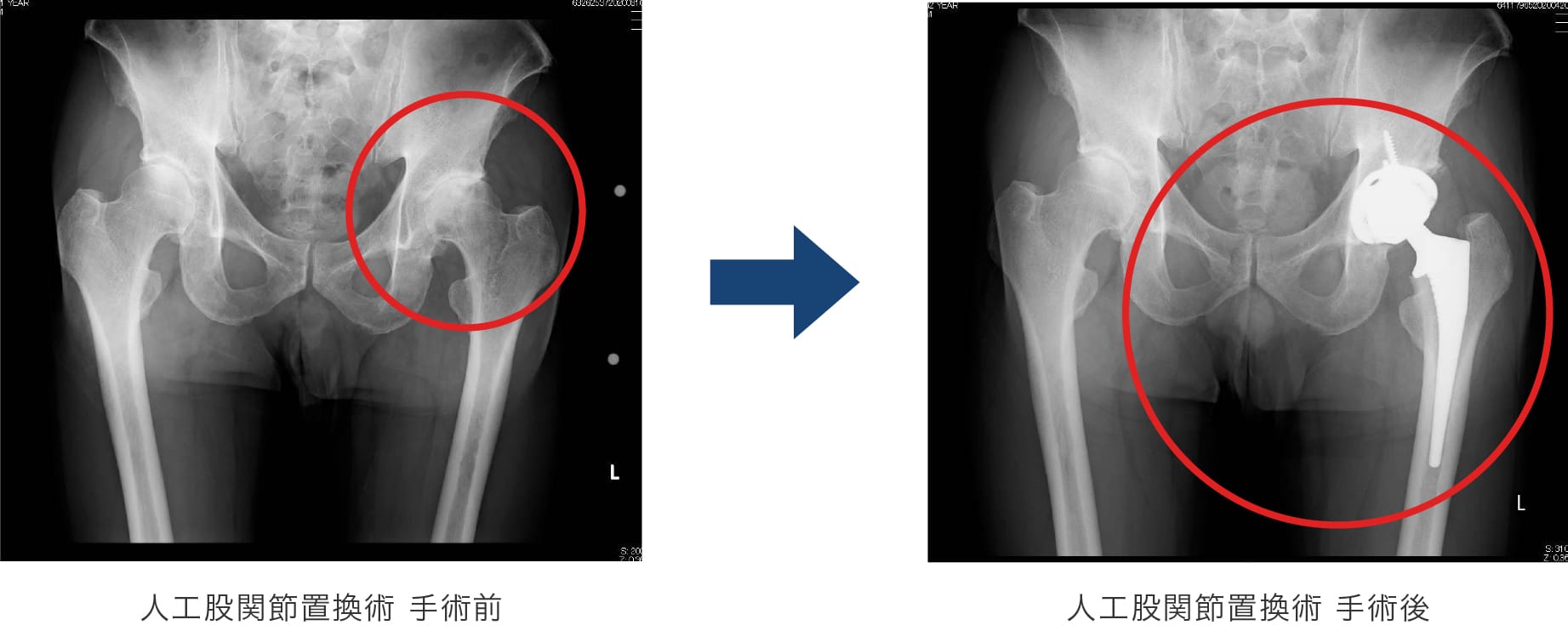 左変形性股関節症