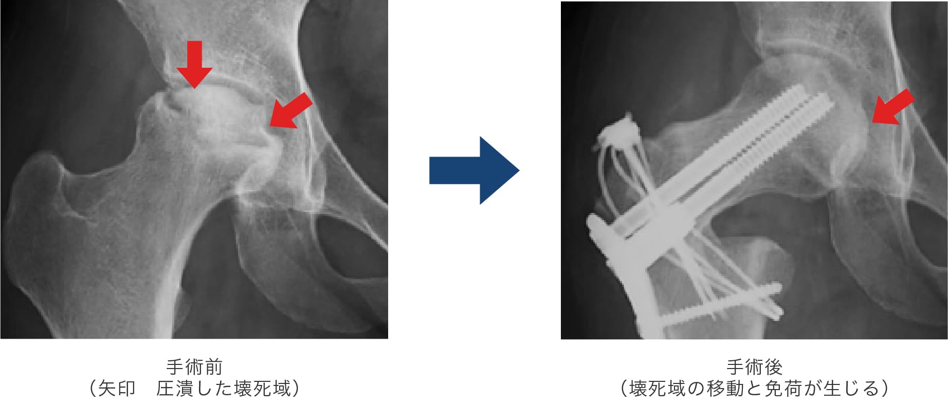 大腿骨頭壊死症