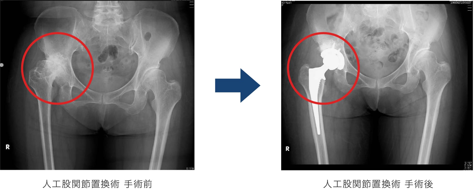 人工股関節置換術　手術前後