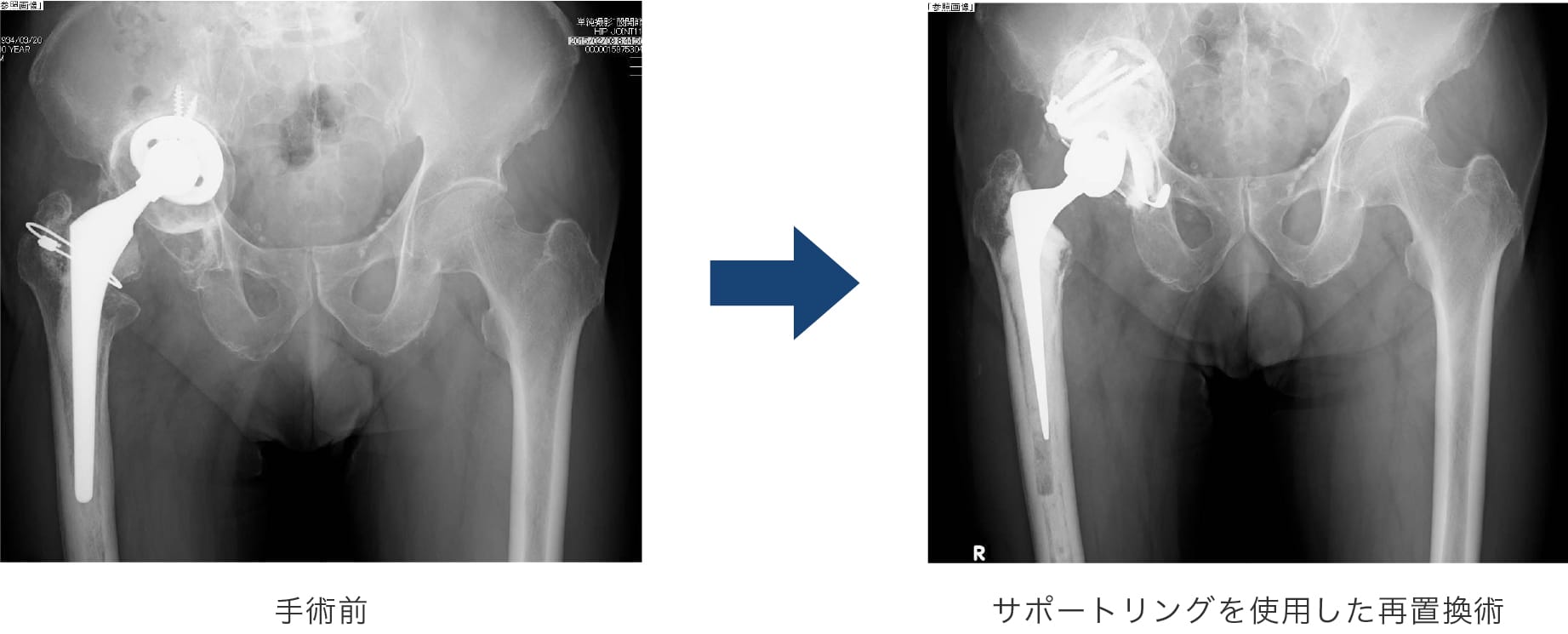 サポートリングを使用した再置換術 手術前後