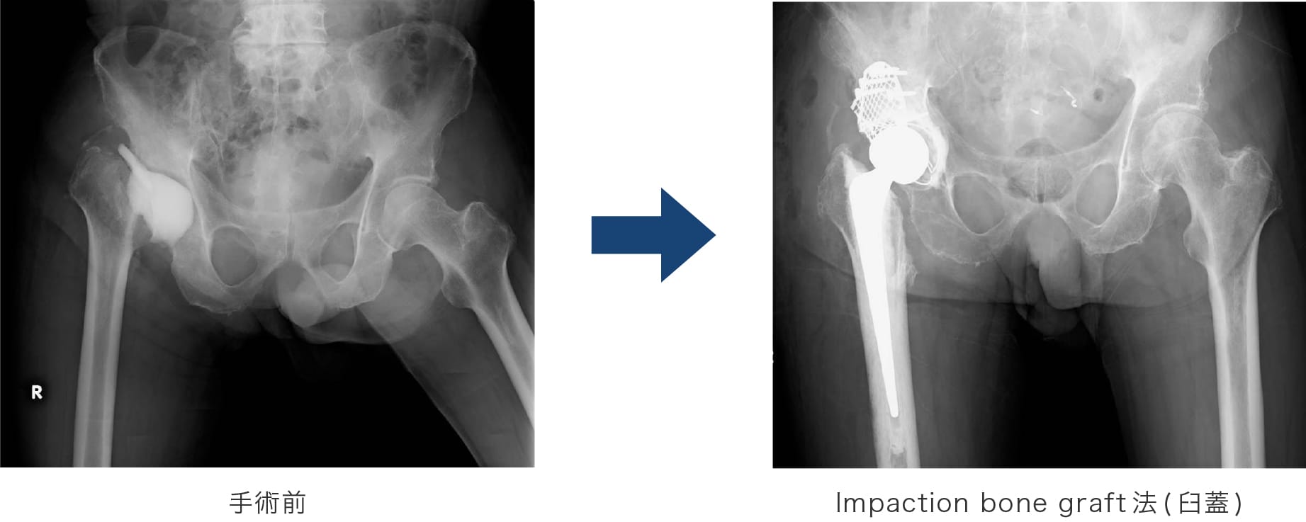 Impaction bone graft法(臼蓋)  手術前後