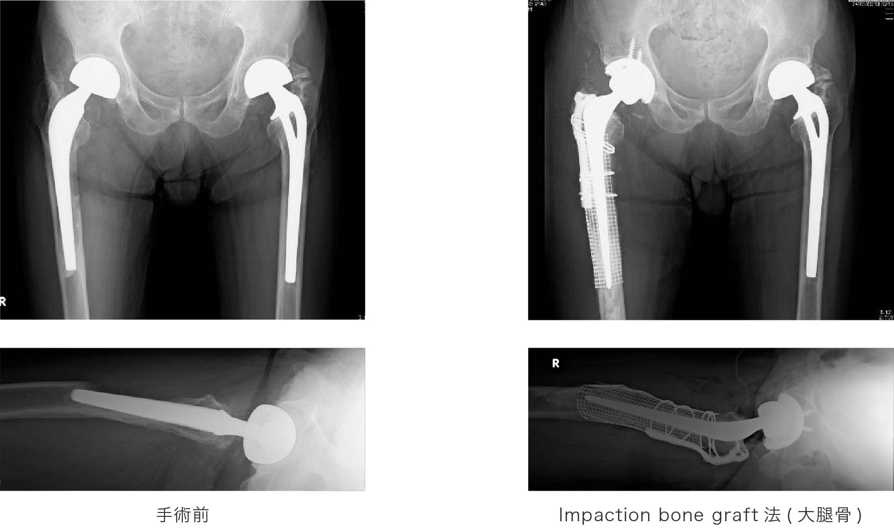 Impaction bone graft法(大腿骨)  手術前後