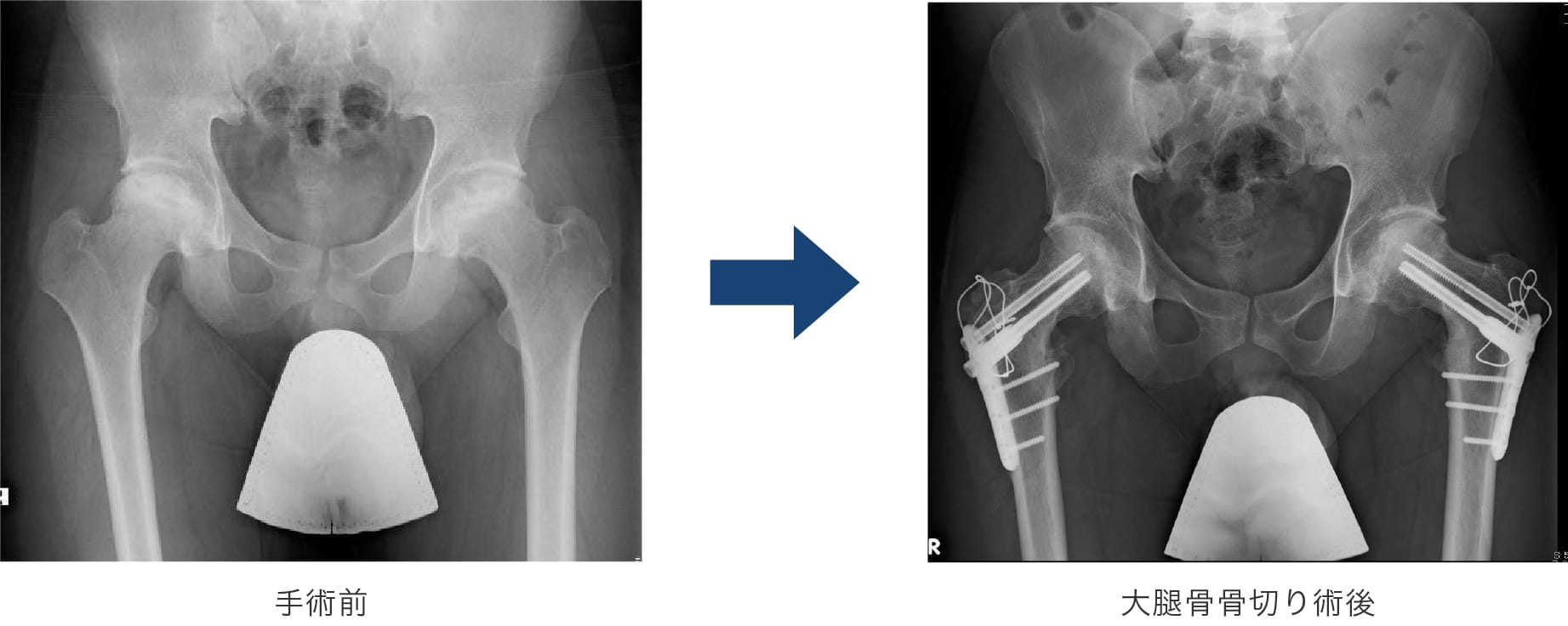 大腿骨骨切り術後 手術前後