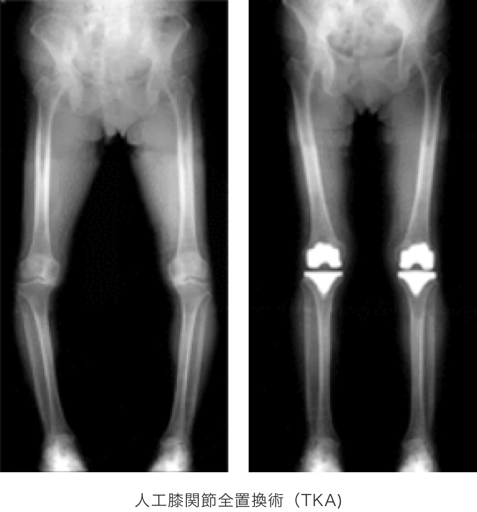 人工膝関節置換術（TKA）