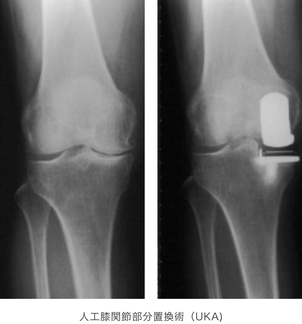 人工膝関節単顆置換術（UKA）