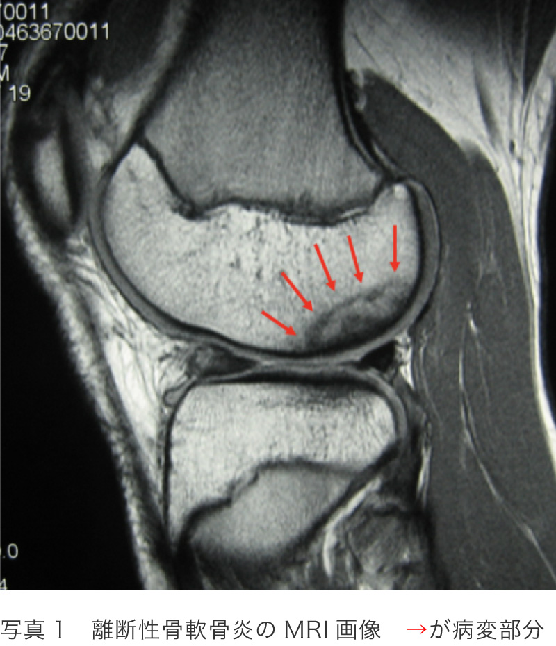 離断性骨軟骨炎のMRI画像