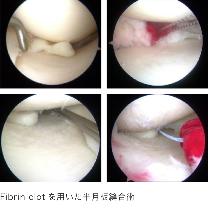 関節鏡下半月板縫合術または関節鏡下部分切除術
